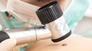 Smrtnost od melanoma 30 odsto